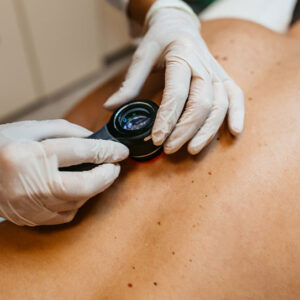 Melanoma: Risk factors, diagnosis and treatment