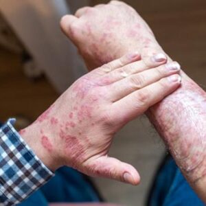 Treatment for Psoriasis
