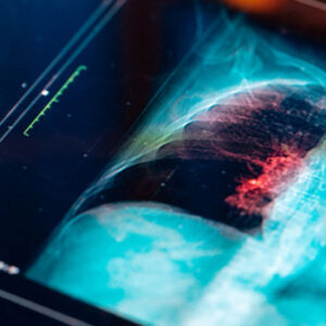 lung cancer screening