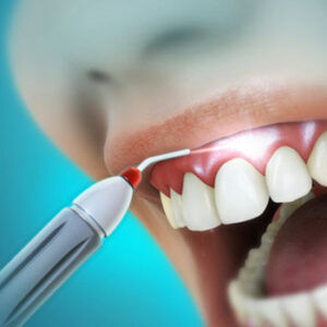 Diode Lasers Integration in routine dental
